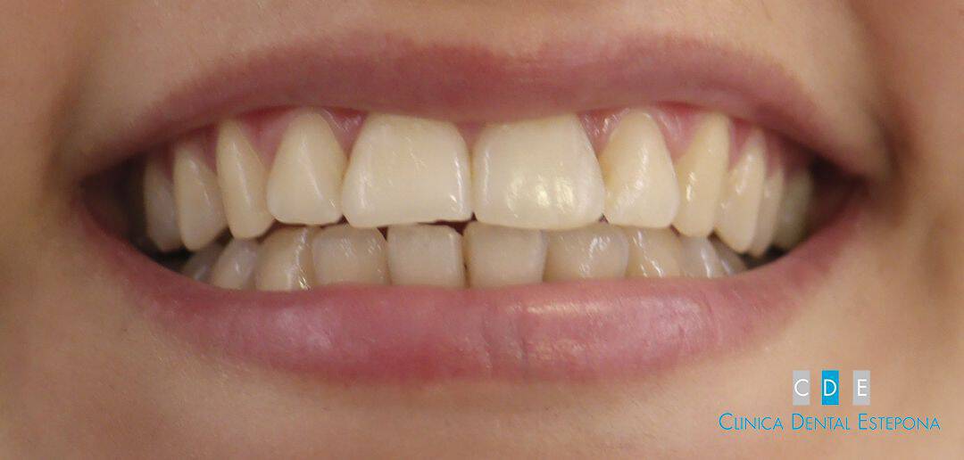 Teeth Brightening — Before