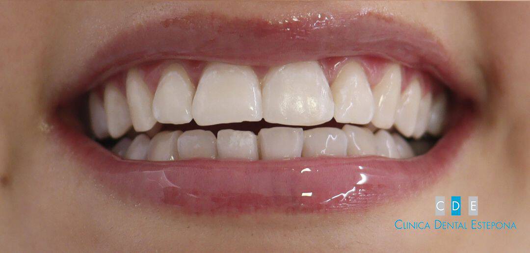 Teeth Brightening — After