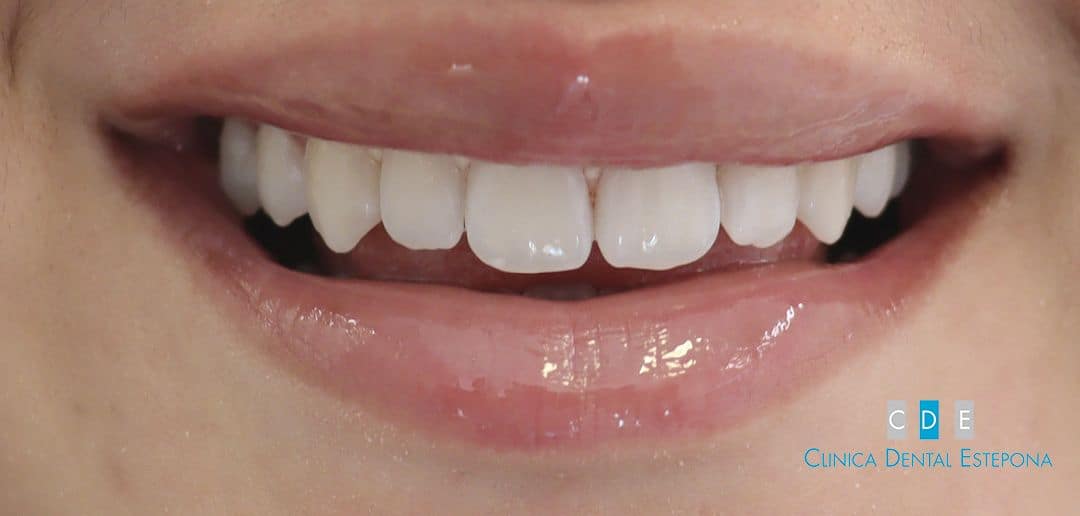 Teeth Brightening — After