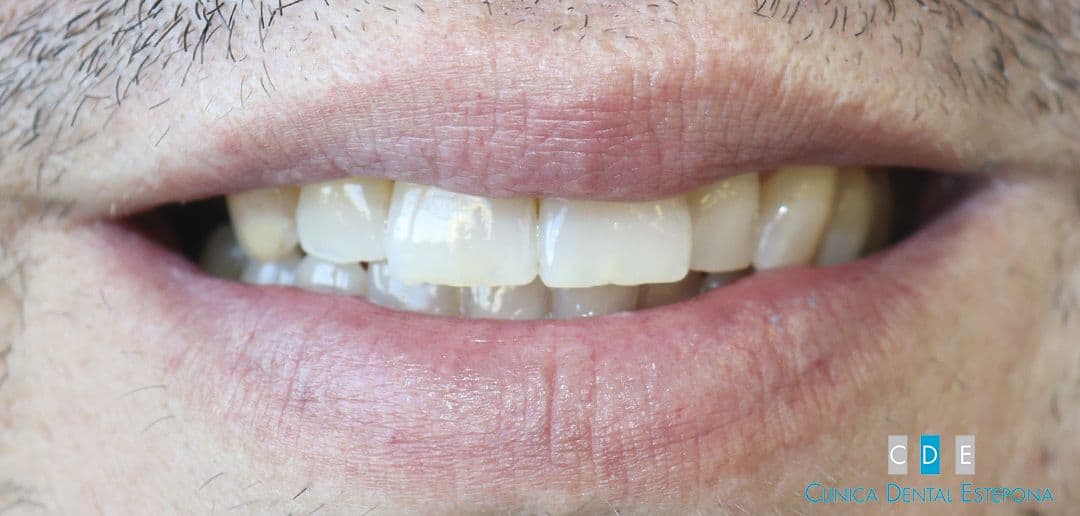 Porcelain Veneers — Before