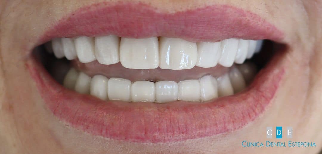 Porcelain Veneers — After