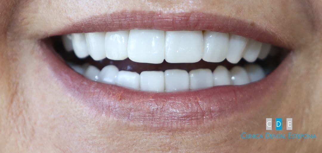 Porcelain Veneers — After